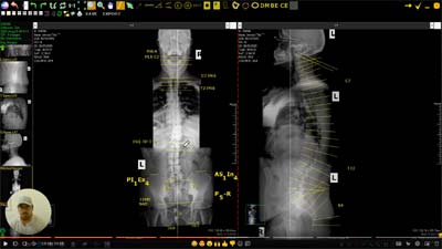 A screenshot of the video I received from Dr. Craig. I was shocked that I could see my spine was in rough shape.